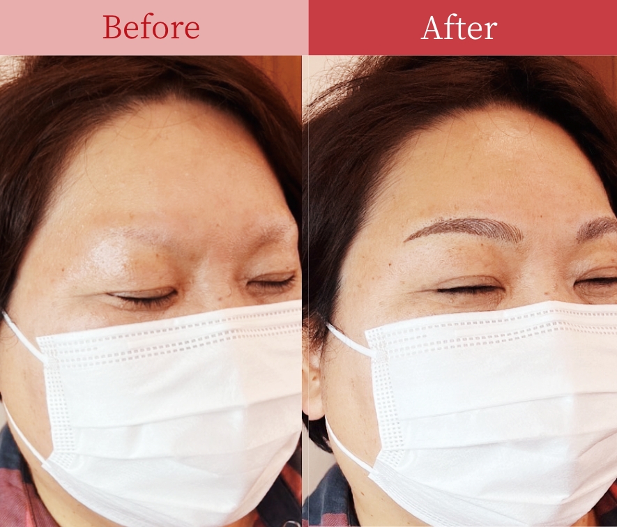 症例04 Before / After