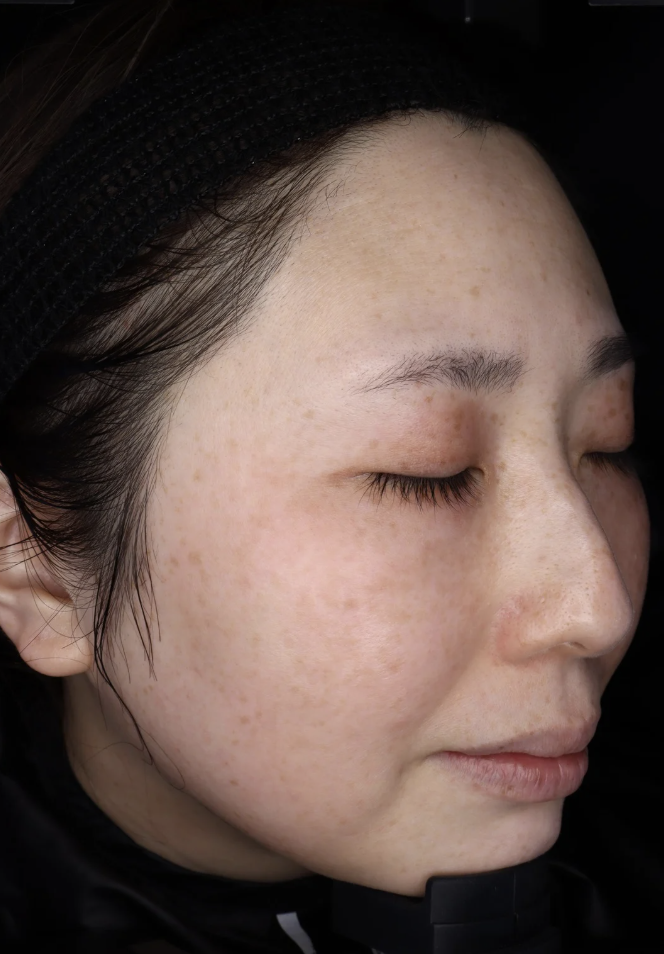 フォトフェイシャル 施術後