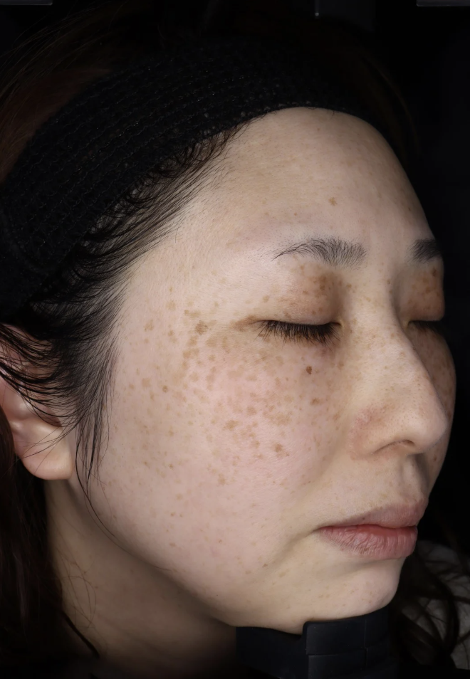フォトフェイシャル 施術前