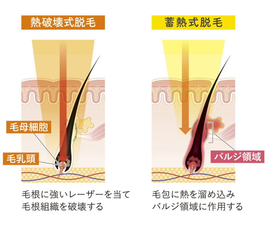 熱破壊式脱毛と蓄熱式脱毛の違い