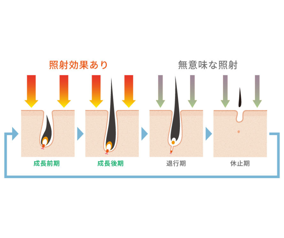 毛周期（成長期・退行期・休止期）と脱毛効果