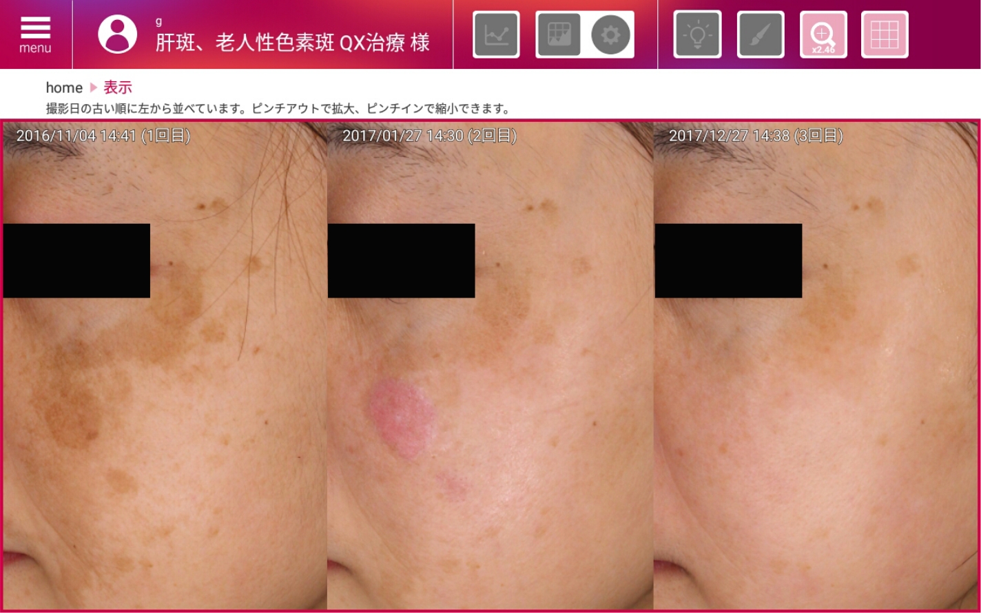 肌の変化を時系列で比較した診断画像